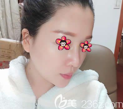 嘉興禾美整形做硅膠隆鼻案例