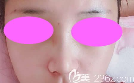 我找吉安天使王小輝做肋骨鼻綜合術(shù)后第9天效果 我找吉安天使王小輝做肋骨鼻綜合術(shù)后第9天效果