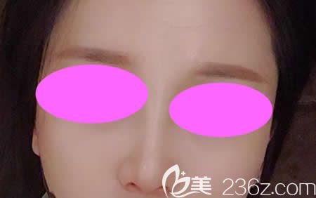 大家看我找吉安天使王小輝花9800塊做的肋骨鼻綜合三個月效果好不好