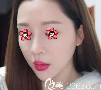 嘉興禾美整容醫(yī)院鼻綜合隆鼻案例