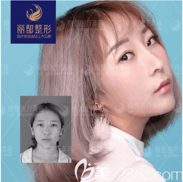 北京米蘭柏羽麗都吳玉家醫(yī)生上瞼下垂矯正案例