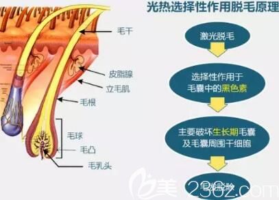 冰點脫毛的作用原理介紹
