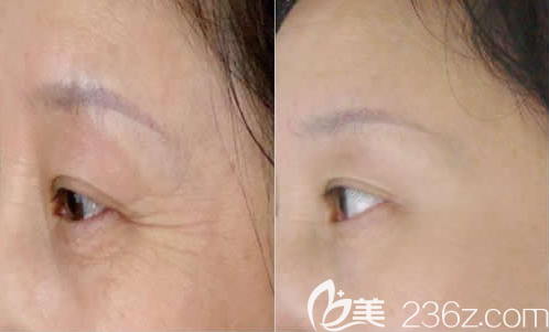 韓國ls整形美容外科去皺案例效果對比圖