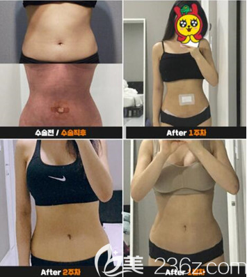韓國babiline整形外科醫(yī)院腰腹吸脂案例效果對(duì)比圖 韓國babiline整形外科醫(yī)院腰腹吸脂案例效果對(duì)比圖