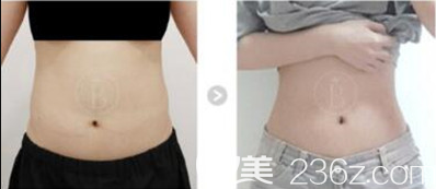 韓國(guó)babiline醫(yī)院鄭熙妍院長(zhǎng)腰腹吸脂案例效果對(duì)比圖 韓國(guó)babiline醫(yī)院鄭熙妍院長(zhǎng)腰腹吸脂案例效果對(duì)比圖