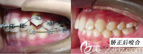 牙齒矯正改變咬合關系效果示意圖 牙齒矯正改變咬合關系效果示意圖