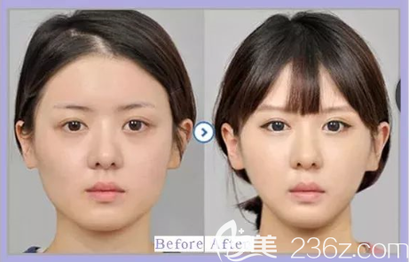 貴陽美貝爾瘦臉效果好不好？