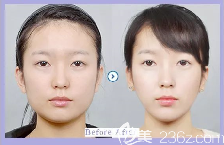 貴陽美貝爾瘦臉效果