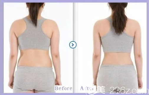貴陽美貝爾吸脂減肥怎么樣