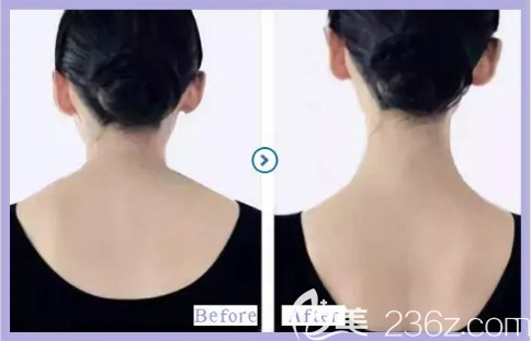 貴陽美貝爾瘦肩