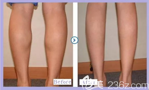 貴陽美貝爾瘦小腿