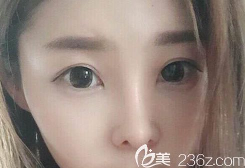 看過呼和浩特五洲鼻整形失敗修復(fù)價(jià)格和真人案例 七天前我找王煥做了自體肋軟骨隆鼻手術(shù)