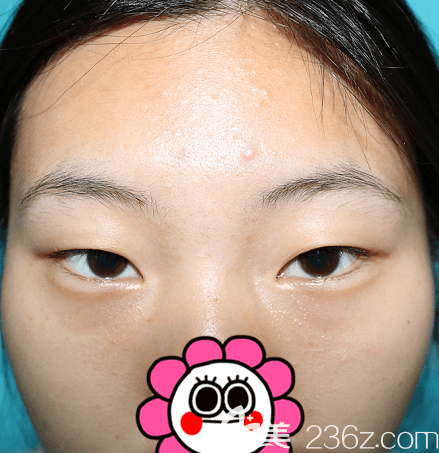 在北京壹加壹找張曉亮醫(yī)生做玖度媚眼前正面照 在北京壹加壹找張曉亮醫(yī)生做玖度媚眼前正面照