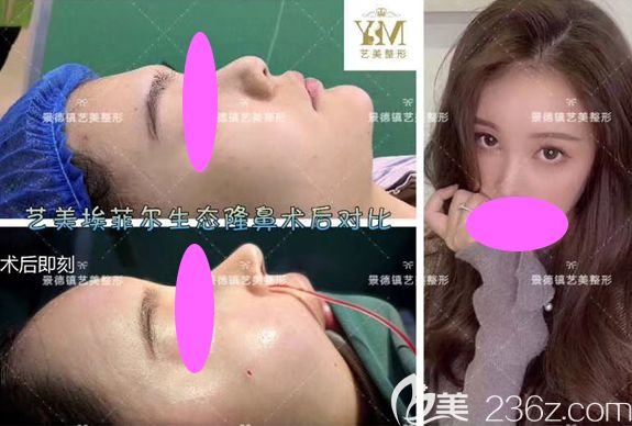 景德鎮(zhèn)藝美整形虞國鋒做的埃菲爾生態(tài)隆鼻術前術后對比圖 景德鎮(zhèn)藝美整形虞國鋒做的埃菲爾生態(tài)隆鼻術前術后對比圖