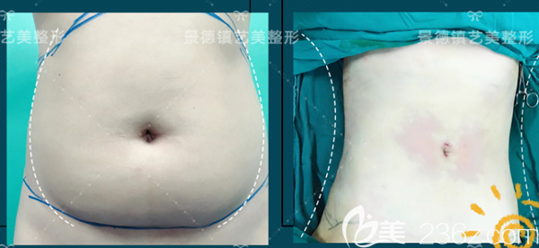景德鎮(zhèn)藝美整形<!--<i data=20240703-sp></i>-->波做的腰腹環(huán)形術后效果對比圖 景德鎮(zhèn)藝美整形<!--<i data=20240703-sp></i>-->波做的腰腹環(huán)形術后效果對比圖