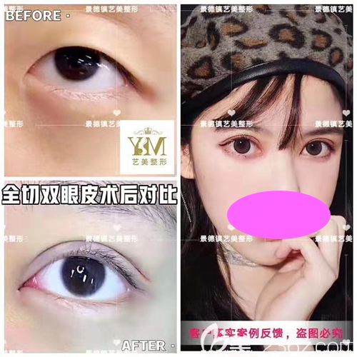 景德鎮(zhèn)藝美整形虞國(guó)鋒全切雙眼皮一個(gè)月恢復(fù)效果圖 景德鎮(zhèn)藝美整形虞國(guó)鋒全切雙眼皮一個(gè)月恢復(fù)效果圖