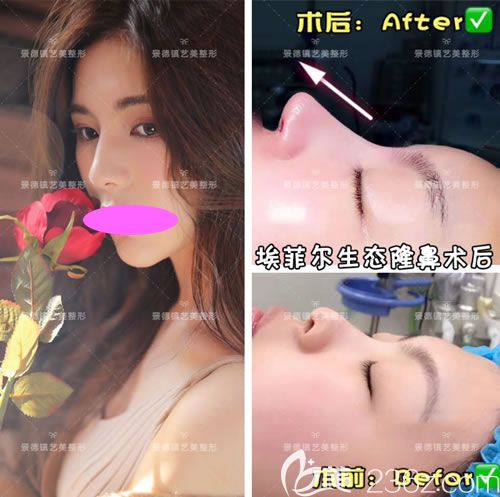 景德鎮(zhèn)藝美整形虞國(guó)鋒埃菲爾生態(tài)隆鼻案例效果圖 景德鎮(zhèn)藝美整形虞國(guó)鋒埃菲爾生態(tài)隆鼻案例效果圖
