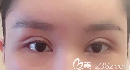 我找景德鎮(zhèn)藝美虞國鋒割7mm開扇形雙眼皮術(shù)后第7天效果圖 我找景德鎮(zhèn)藝美虞國鋒割7mm開扇形雙眼皮術(shù)后第7天效果圖