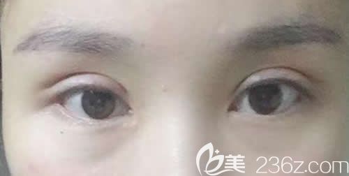 我找景德鎮(zhèn)藝美虞國鋒割7mm開扇形雙眼皮術(shù)后第22天恢復(fù)效果圖 我找景德鎮(zhèn)藝美虞國鋒割7mm開扇形雙眼皮術(shù)后第22天恢復(fù)效果圖