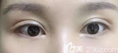和大家分享我找景德鎮(zhèn)藝美整形虞國鋒割7mm開扇形雙眼皮的親身經(jīng)歷