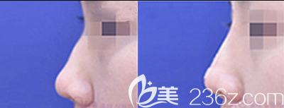 韓國(guó)奧來(lái)OLE整形外科醫(yī)院洪基錫駝峰鼻矯正案例 韓國(guó)奧來(lái)OLE整形外科醫(yī)院洪基錫駝峰鼻矯正案例