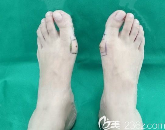 包頭華美整形美容醫(yī)院治療大腳骨前 包頭華美整形美容醫(yī)院治療大腳骨前