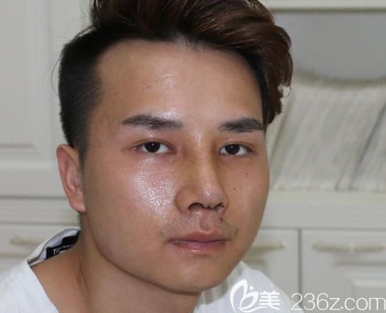 自體肋軟骨綜合隆鼻第7天拆線后圖片 自體肋軟骨綜合隆鼻第7天拆線后圖片