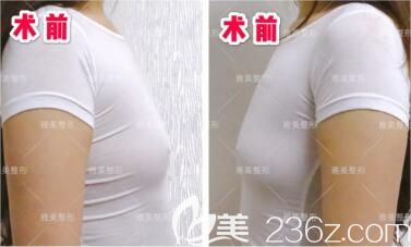 做傲諾拉假體隆胸術(shù)前照 做傲諾拉假體隆胸術(shù)前照