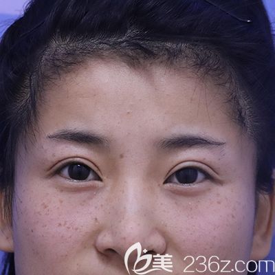 到哈爾濱臻美做眼修復(fù)前 到哈爾濱臻美做眼修復(fù)前