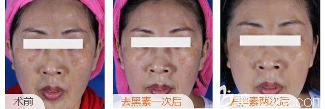 在蘇州美貝爾做激光祛斑術(shù)后案例