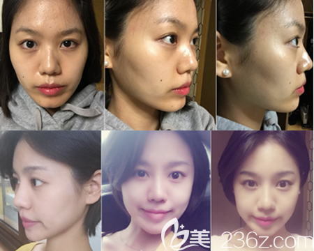 韓國那木面部提升案例