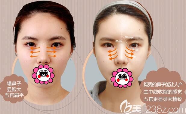 哈爾濱臻美王丹丹隆鼻案例效果