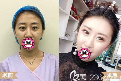 哈爾濱臻美自體脂肪面部填充案例