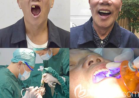 口腔種植牙案例效果圖 口腔種植牙案例效果圖