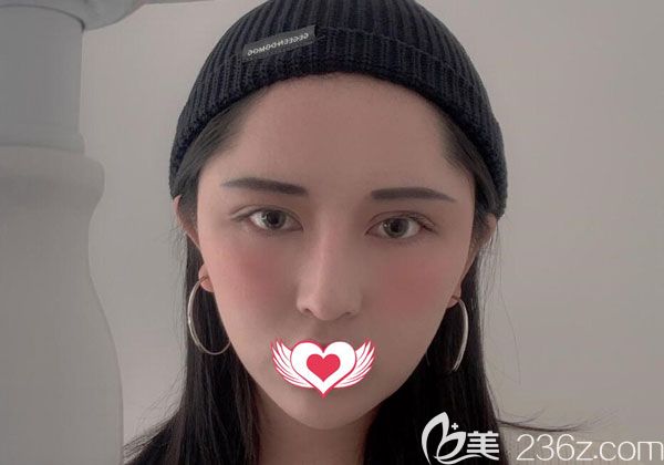 光纖溶脂瘦臉第20天臉小了一圈 光纖溶脂瘦臉第20天臉小了一圈