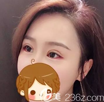 華美王金紅切開雙眼皮半個(gè)月圖片 華美王金紅切開雙眼皮半個(gè)月圖片