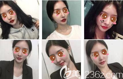 上海時光整形外科醫(yī)院自體脂肪面部填充真人案例 上海時光整形外科醫(yī)院自體脂肪面部填充真人案例