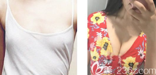 包頭葉子張會堂假體隆胸效果怎么樣