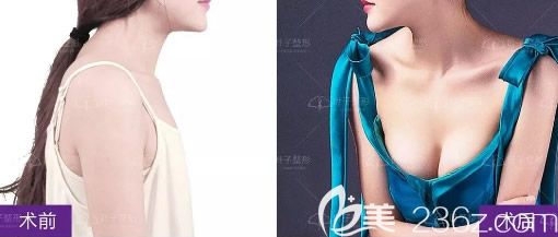 包頭葉子隋立強假體隆胸案例