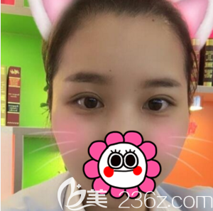 在北京京韓做切開雙眼皮開眼角一月效果 在北京京韓做切開雙眼皮開眼角一月效果