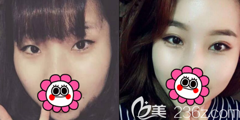 北京京韓開眼角切開雙眼皮案例 北京京韓開眼角切開雙眼皮案例