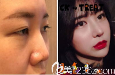 韓國Glory整形外科姜車榮鼻綜合隆鼻案例效果對比圖 韓國Glory整形外科姜車榮鼻綜合隆鼻案例效果對比圖