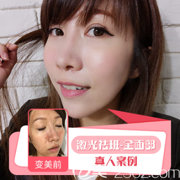 <!--<i data=20240703-sp></i>-->激光祛斑案例