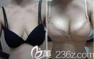 韓國(guó)Glory整形蓓拉假體隆胸真實(shí)案例效果對(duì)比圖 韓國(guó)Glory整形蓓拉假體隆胸真實(shí)案例效果對(duì)比圖