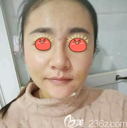 永康光大醫(yī)院光纖溶脂瘦臉案例