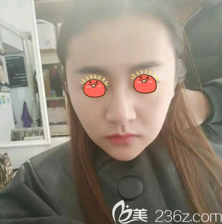 永康光大光纖溶脂瘦臉15天照片