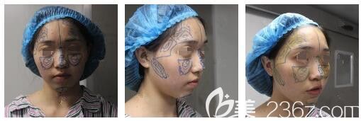 面診南通儷人連天美醫(yī)生術前劃線設計 面診南通儷人連天美醫(yī)生術前劃線設計