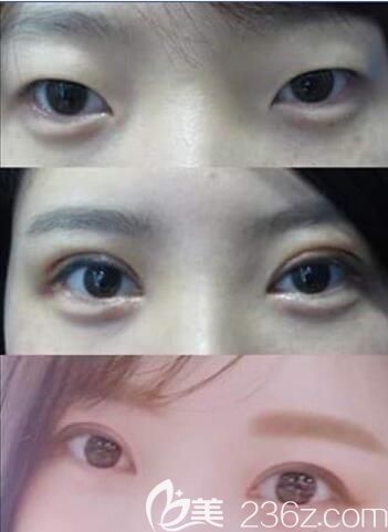 韓國蠟筆Crapas整形外科鄭美善韓式無痕雙眼皮案例恢復(fù)過程圖 韓國蠟筆Crapas整形外科鄭美善韓式無痕雙眼皮案例恢復(fù)過程圖