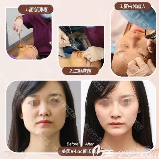 在常熟時(shí)代做線雕提升術(shù)前術(shù)后對(duì)比