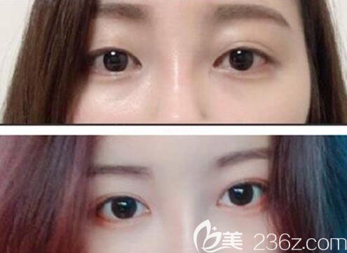 韓國Crapas蠟筆整形外科鄭美善雙眼皮案例 韓國Crapas蠟筆整形外科鄭美善雙眼皮案例